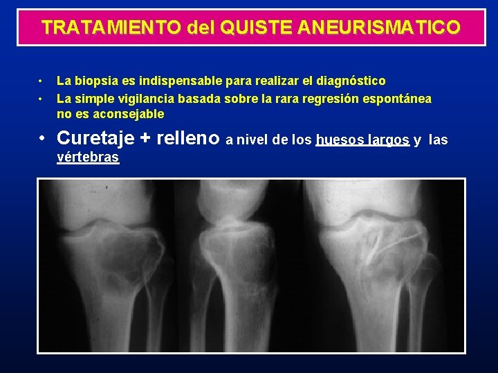 TRATAMIENTO del QUISTE ANEURISMATICO • • La biopsia es indispensable para realizar el diagnóstico TRATAMIENTO del QUISTE ANEURISMATICO • • La biopsia es indispensable para realizar el diagnóstico
