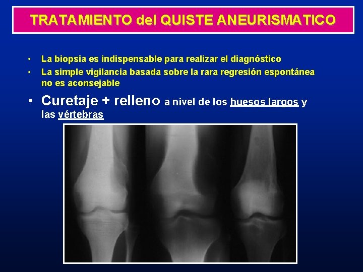 TRATAMIENTO del QUISTE ANEURISMATICO • • La biopsia es indispensable para realizar el diagnóstico TRATAMIENTO del QUISTE ANEURISMATICO • • La biopsia es indispensable para realizar el diagnóstico