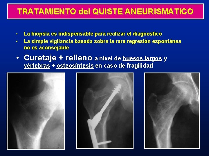 TRATAMIENTO del QUISTE ANEURISMATICO • • La biopsia es indispensable para realizar el diagnostico TRATAMIENTO del QUISTE ANEURISMATICO • • La biopsia es indispensable para realizar el diagnostico