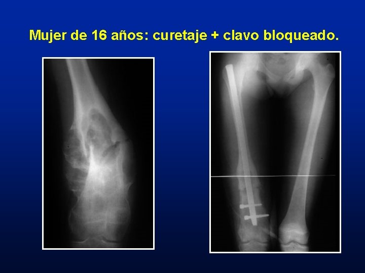 Mujer de 16 años: curetaje + clavo bloqueado. 