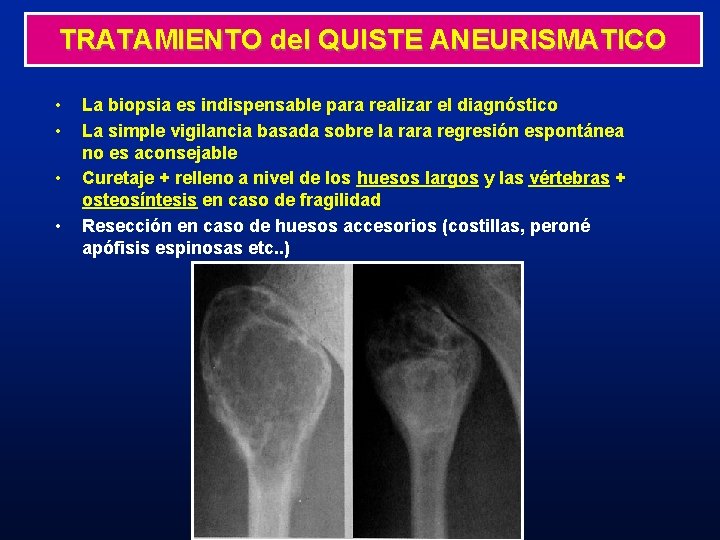 TRATAMIENTO del QUISTE ANEURISMATICO • • La biopsia es indispensable para realizar el diagnóstico