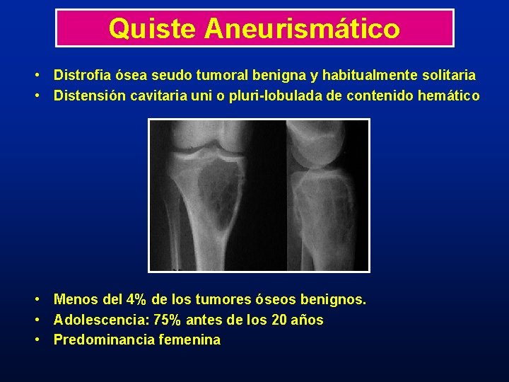 Quiste Aneurismático • Distrofia ósea seudo tumoral benigna y habitualmente solitaria • Distensión cavitaria