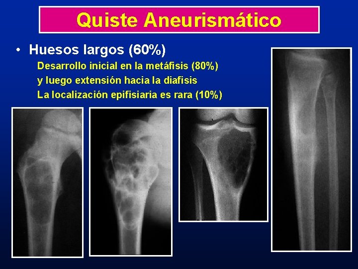 Quiste Aneurismático • Huesos largos (60%) Desarrollo inicial en la metáfisis (80%) y luego Quiste Aneurismático • Huesos largos (60%) Desarrollo inicial en la metáfisis (80%) y luego