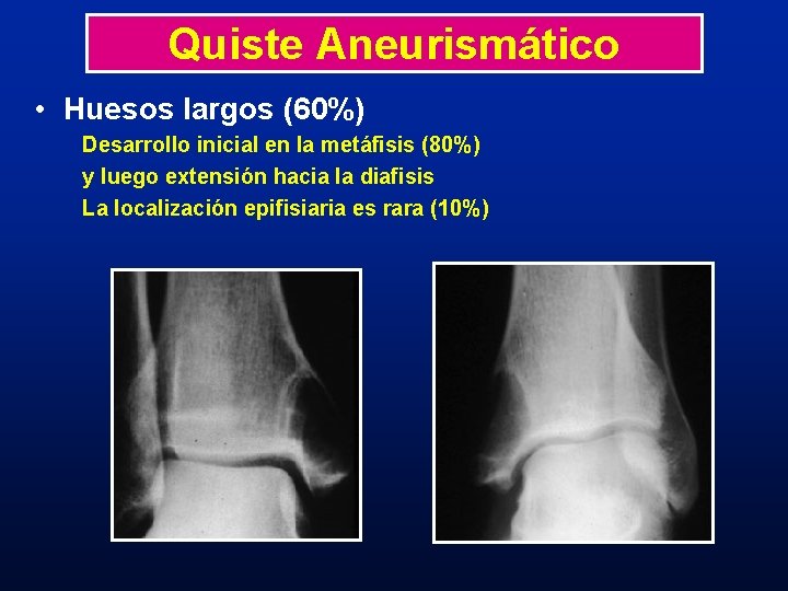 Quiste Aneurismático • Huesos largos (60%) Desarrollo inicial en la metáfisis (80%) y luego