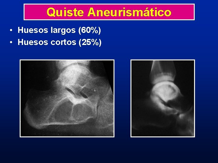 Quiste Aneurismático • Huesos largos (60%) • Huesos cortos (25%) 