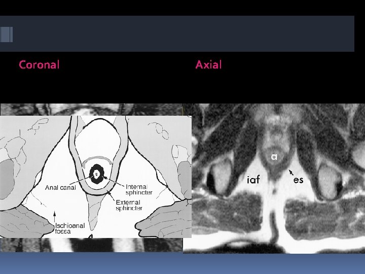 Coronal Axial 