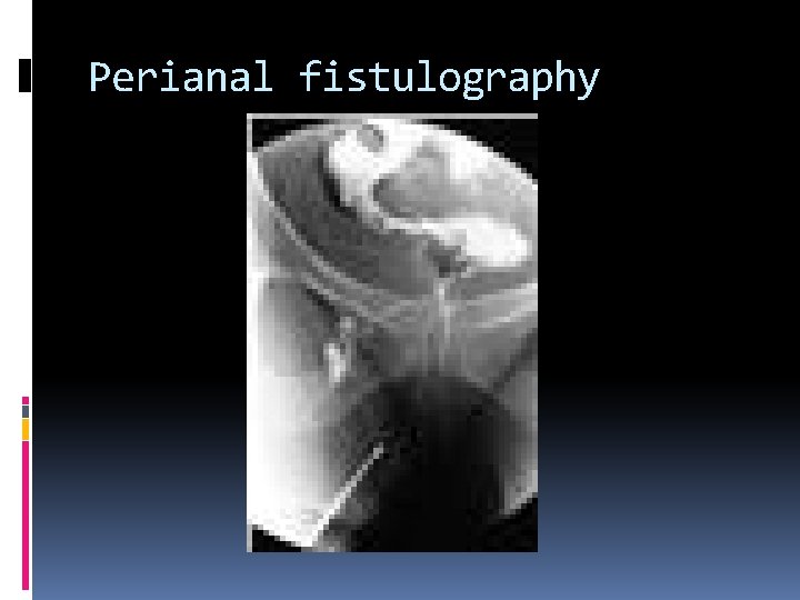 Perianal fistulography 