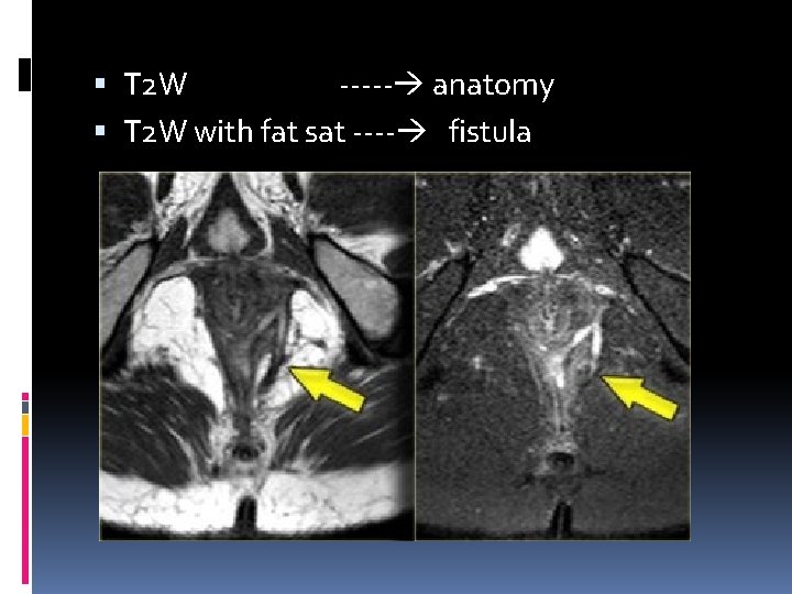  T 2 W ----- anatomy T 2 W with fat sat ---- fistula
