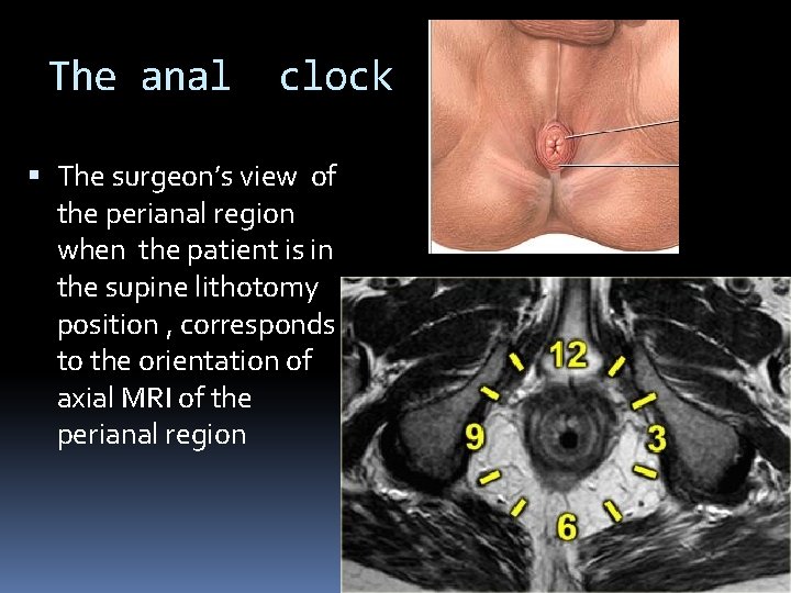 The anal clock The surgeon’s view of the perianal region when the patient is