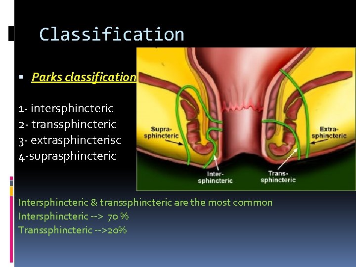 Classification Parks classification 1 - intersphincteric 2 - transsphincteric 3 - extrasphincterisc 4 -suprasphincteric