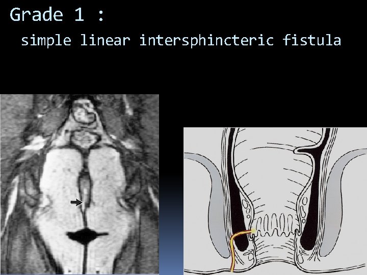 Grade 1 : simple linear intersphincteric fistula 