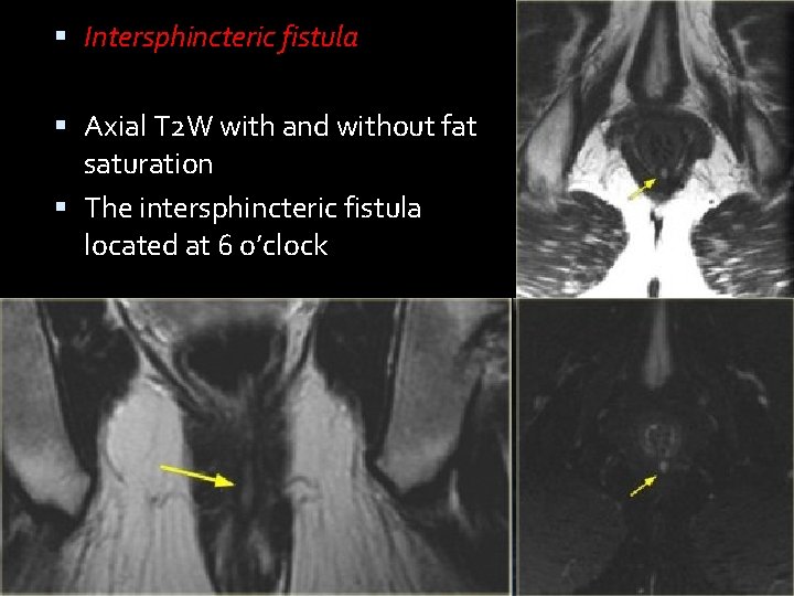  Intersphincteric fistula Axial T 2 W with and without fat saturation The intersphincteric