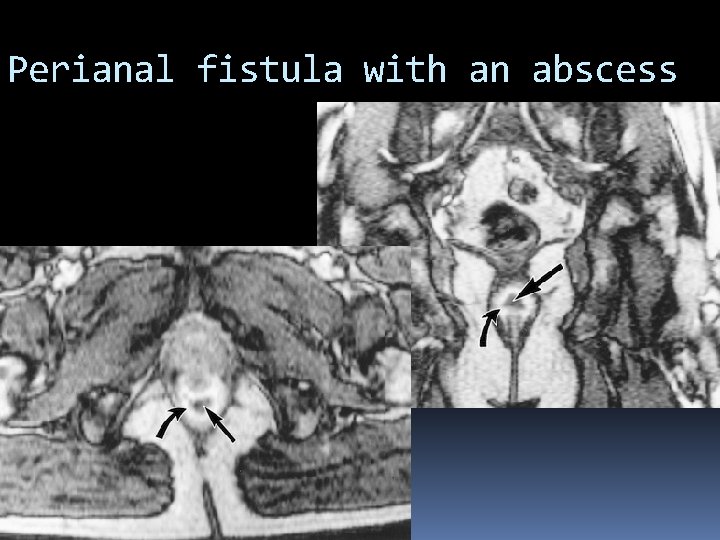 Perianal fistula with an abscess 