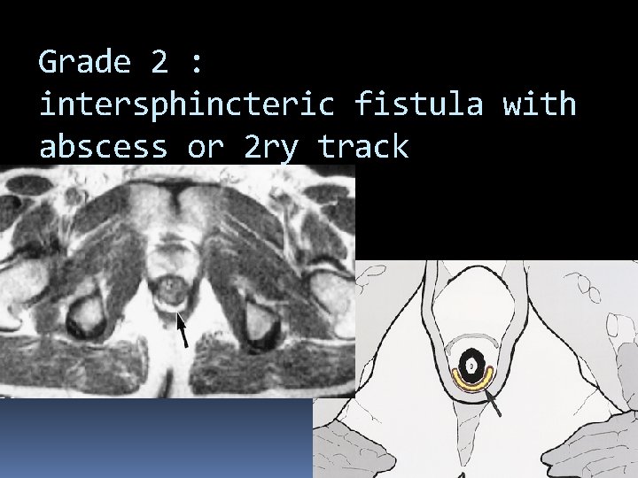 Grade 2 : intersphincteric fistula with abscess or 2 ry track 