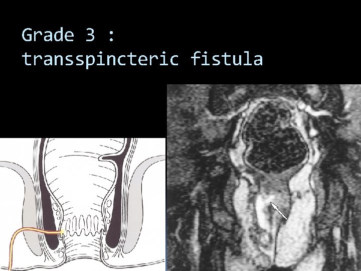 Grade 3 : transspincteric fistula 