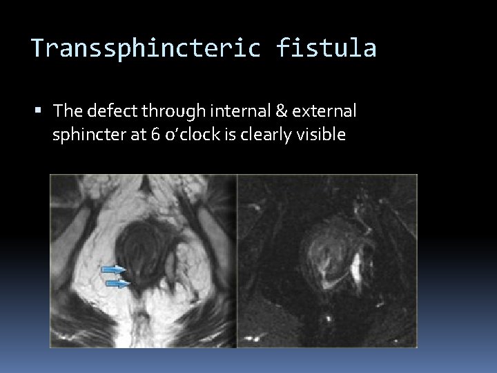 Transsphincteric fistula The defect through internal & external sphincter at 6 o’clock is clearly