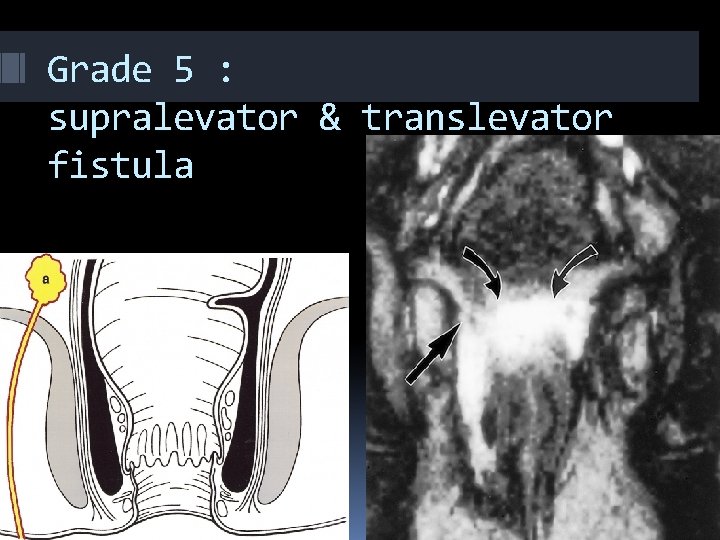 Grade 5 : supralevator & translevator fistula 
