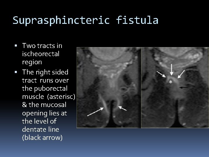 Suprasphincteric fistula Two tracts in ischeorectal region The right sided tract runs over the