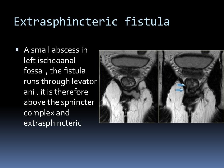 Extrasphincteric fistula A small abscess in left ischeoanal fossa , the fistula runs through