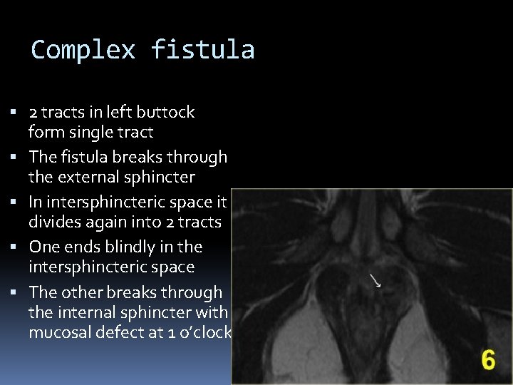 Complex fistula 2 tracts in left buttock form single tract The fistula breaks through