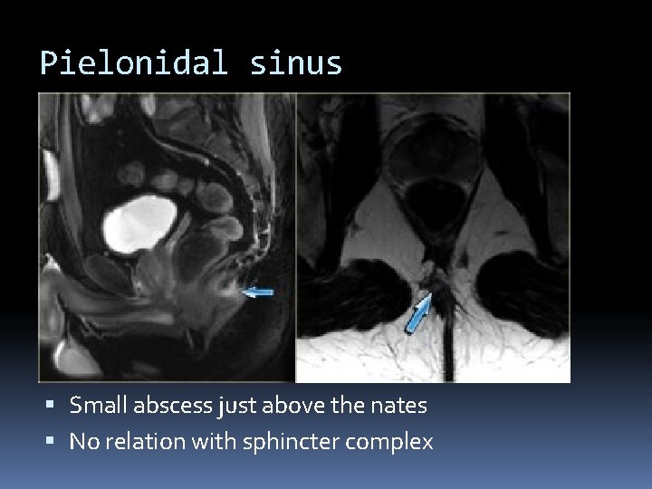 Pielonidal sinus Small abscess just above the nates No relation with sphincter complex 