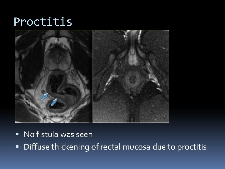 Proctitis No fistula was seen Diffuse thickening of rectal mucosa due to proctitis 