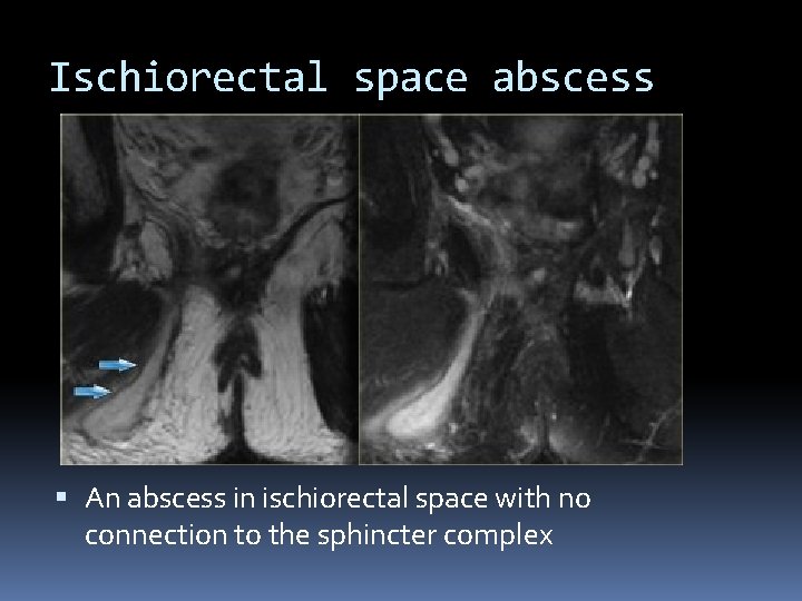 Ischiorectal space abscess An abscess in ischiorectal space with no connection to the sphincter