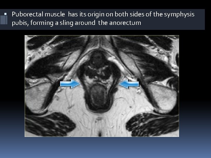  Puborectal muscle has its origin on both sides of the symphysis pubis, forming