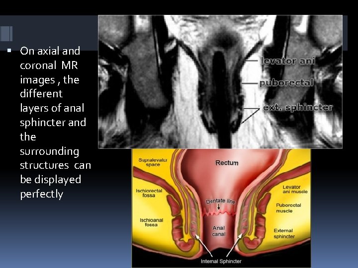  On axial and coronal MR images , the different layers of anal sphincter