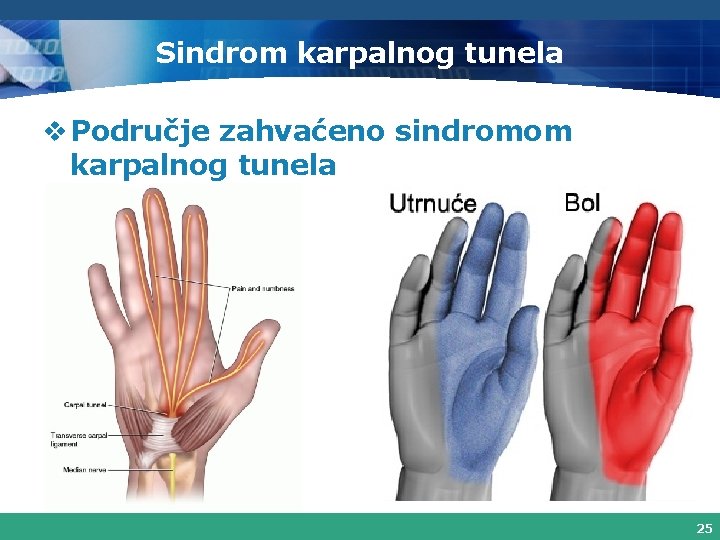 Sindrom karpalnog tunela v Područje zahvaćeno sindromom karpalnog tunela 25 