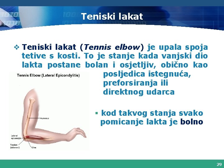 Teniski lakat v Teniski lakat (Tennis elbow) je upala spoja tetive s kosti. To