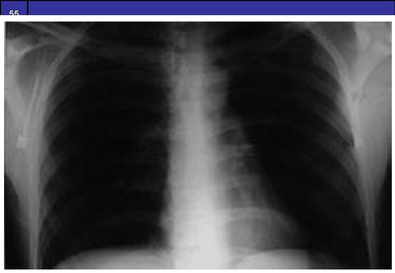 55 of 54 Highpass Filtering Example 55 of 54 Highpass Filtering Example