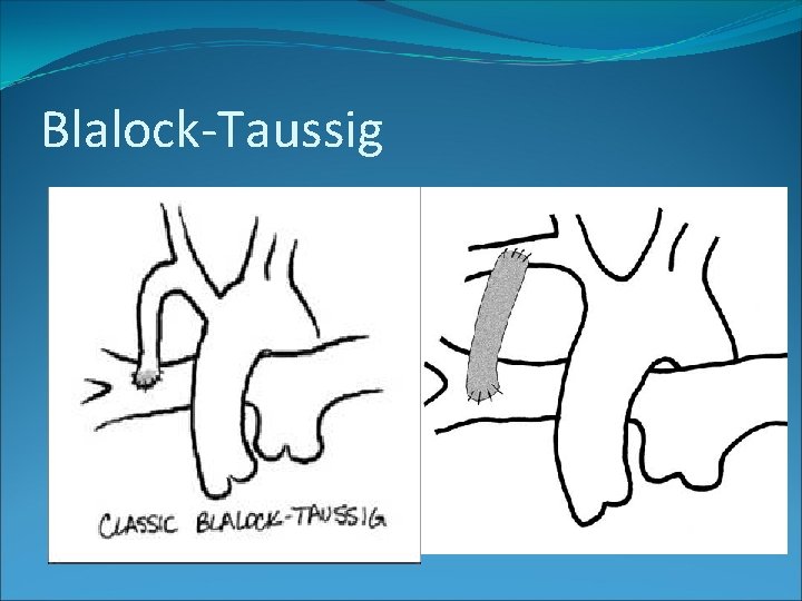 Blalock-Taussig 