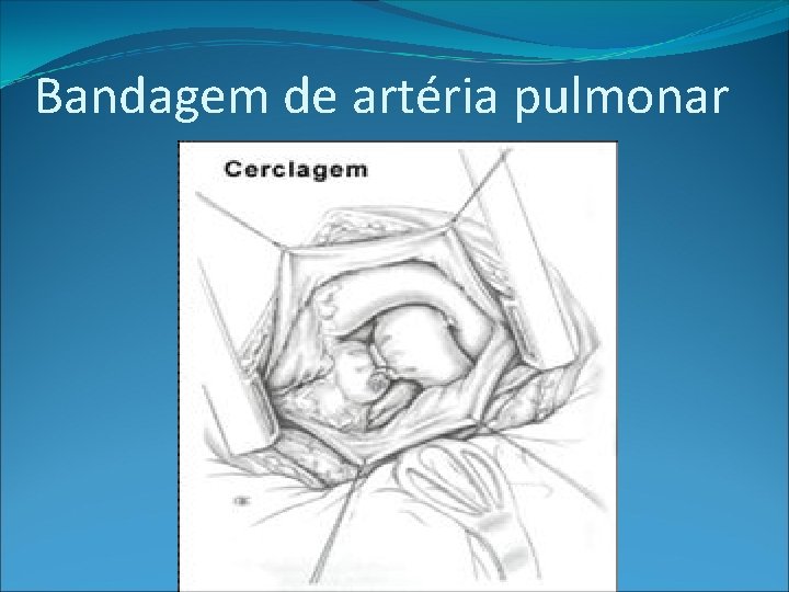 Bandagem de artéria pulmonar 