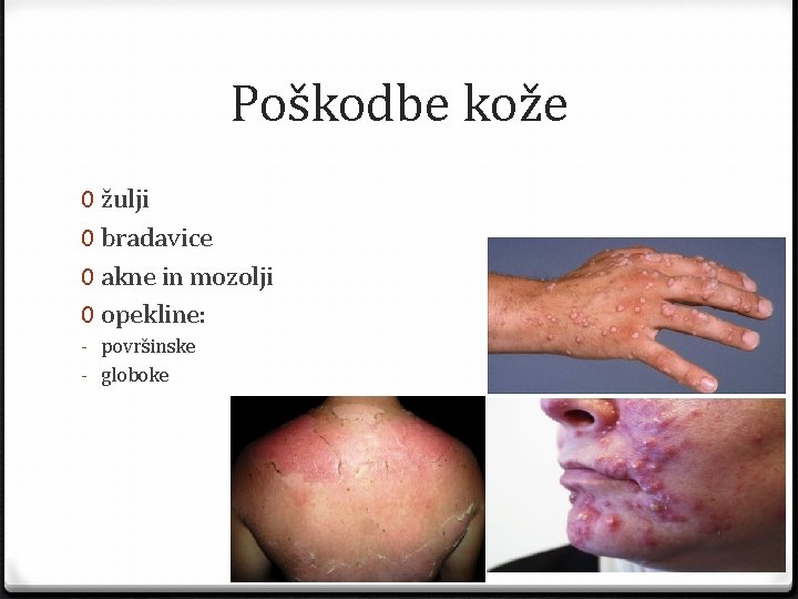 Poškodbe kože 0 žulji 0 bradavice 0 akne in mozolji 0 opekline: - površinske