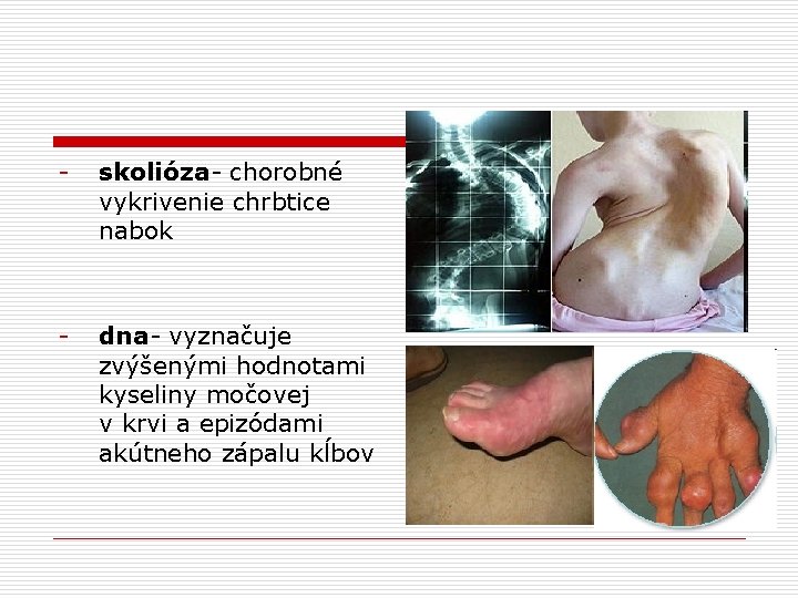 - skolióza- chorobné vykrivenie chrbtice nabok - dna- vyznačuje zvýšenými hodnotami kyseliny močovej v