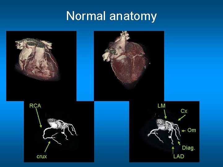 Normal anatomy RCA LM LM Cx Om Diag. crux LAD 