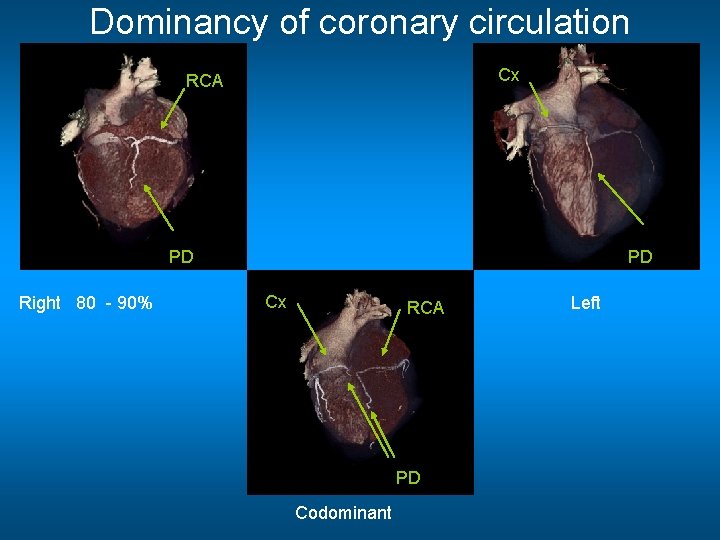 Dominancy of coronary circulation Cx RCA PD Right 80 - 90% PD Cx RCA