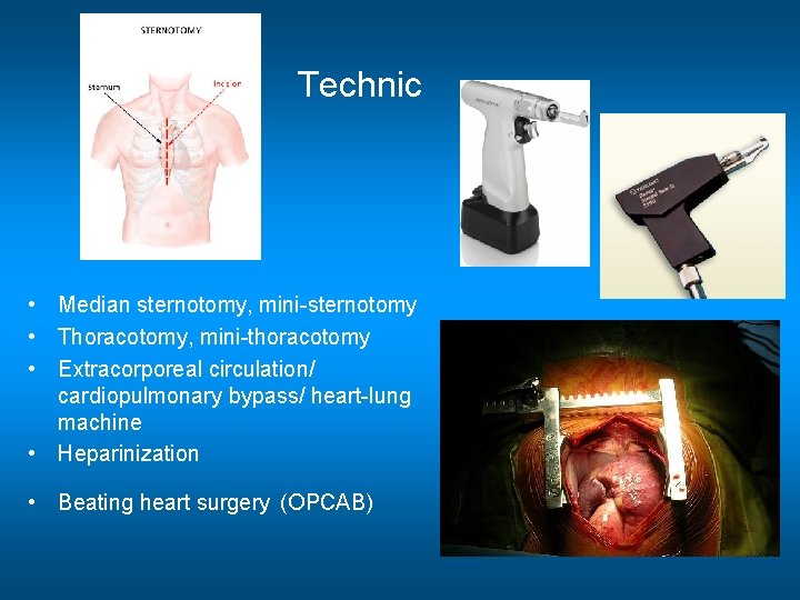 Technic • Median sternotomy, mini-sternotomy • Thoracotomy, mini-thoracotomy • Extracorporeal circulation/ cardiopulmonary bypass/ heart-lung