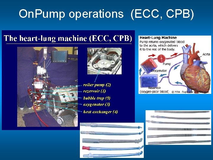On. Pump operations (ECC, CPB) 
