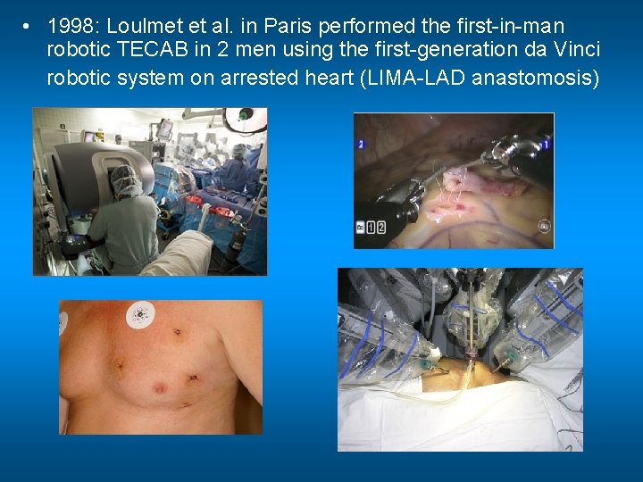  • 1998: Loulmet et al. in Paris performed the first-in-man robotic TECAB in