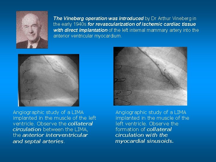  • The Vineberg operation was introduced by Dr Arthur Vineberg in the early