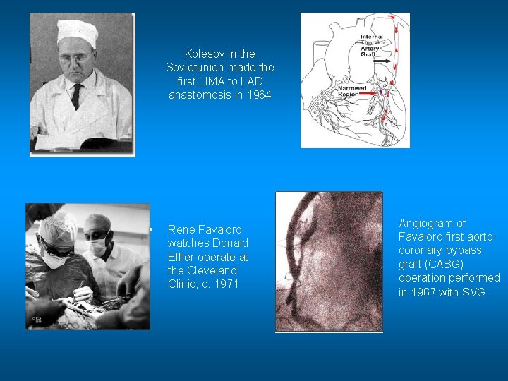 Kolesov in the Sovietunion made the first LIMA to LAD anastomosis in 1964 •