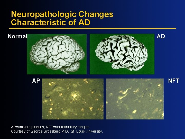 Neuropathologic Changes Characteristic of AD Normal AD AP AP=amyloid plaques; NFT=neurofibrillary tangles Courtesy of Neuropathologic Changes Characteristic of AD Normal AD AP AP=amyloid plaques; NFT=neurofibrillary tangles Courtesy of