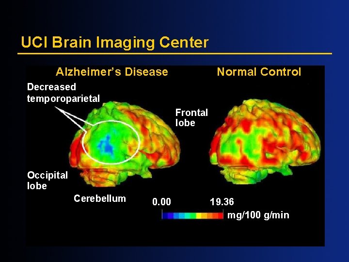 UCI Brain Imaging Center Alzheimer’s Disease Normal Control Decreased temporoparietal Frontal lobe Occipital lobe