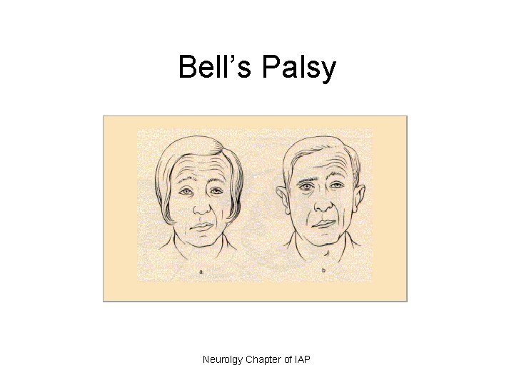 Bell’s Palsy • Neurolgy Chapter of IAP 