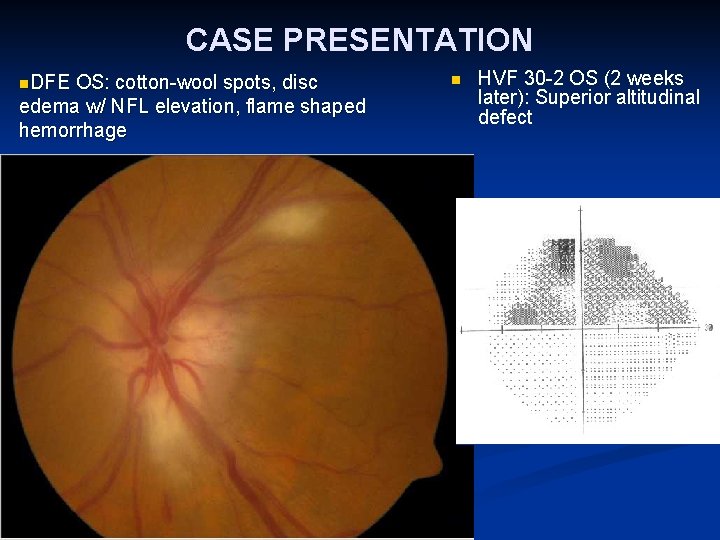 CASE PRESENTATION n. DFE OS: cotton-wool spots, disc edema w/ NFL elevation, flame shaped