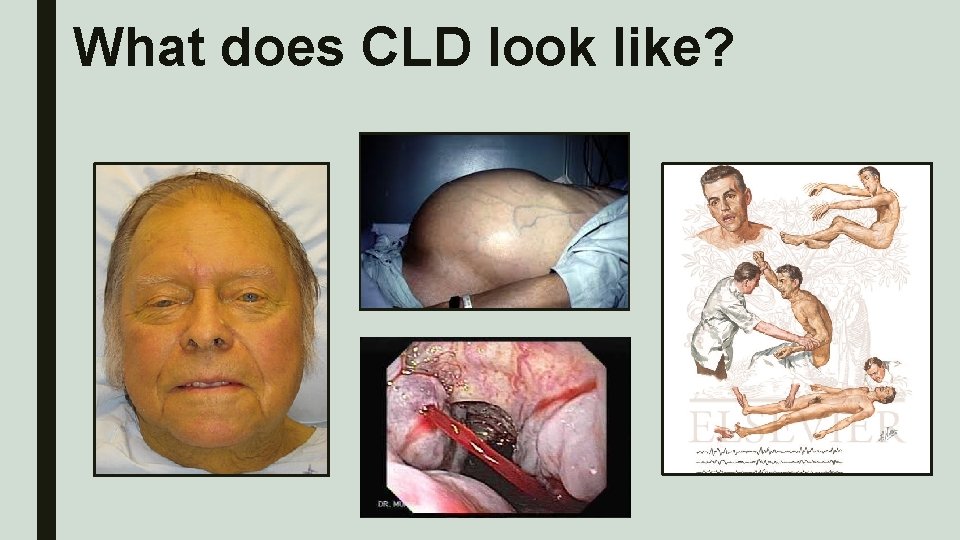 What does CLD look like? What does CLD look like?