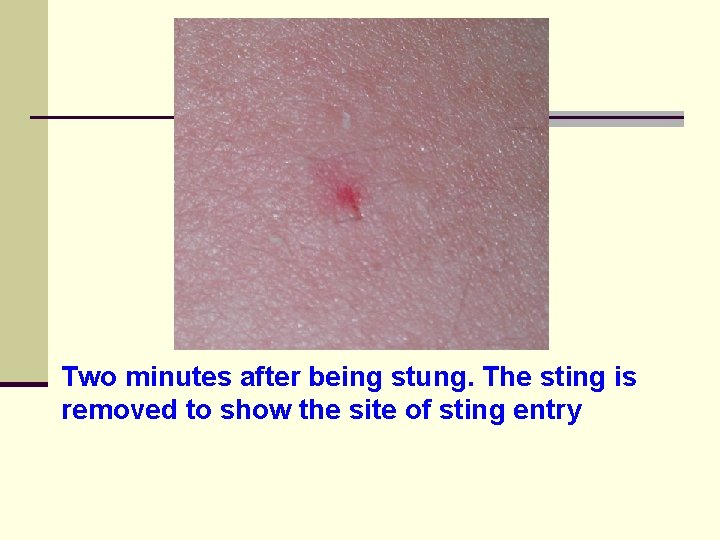 Two minutes after being stung. The sting is removed to show the site of