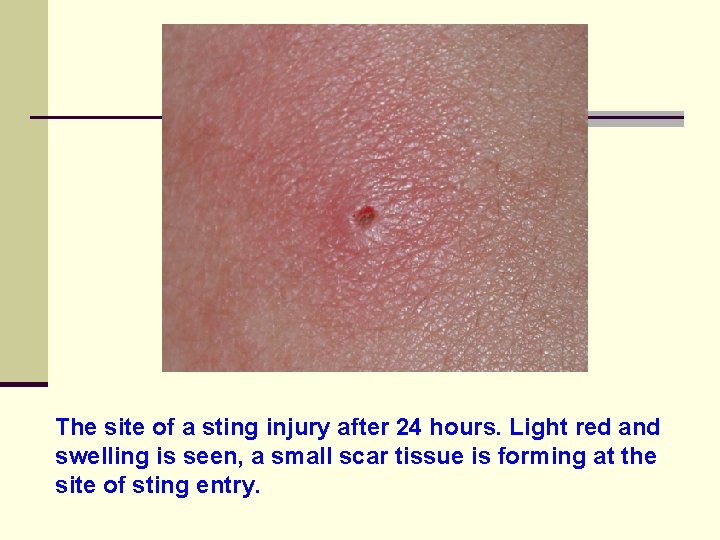 The site of a sting injury after 24 hours. Light red and swelling is